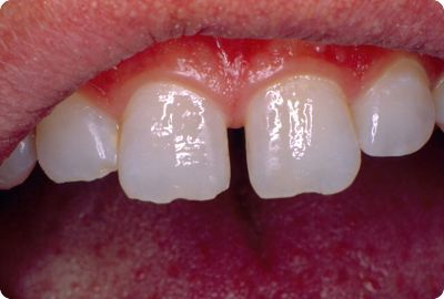 Teeth before dental bonding