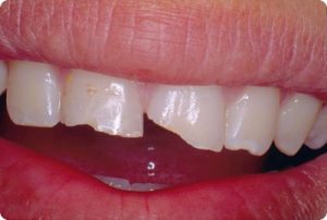 Dental Emergency: Fractured teeth requires a Smithtown Emergency Dentist Dental Emergency: Fractured teeth requires a Smithtown Emergency Dentist