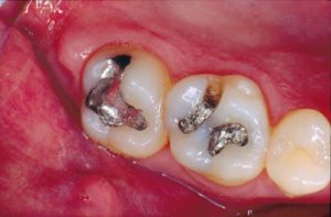 Dental fillings to repair teeth Silver Fillings Before Removal