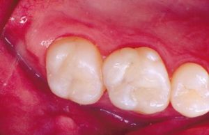 Repairing roof of teeth using dental fillings New Composite Fillings
