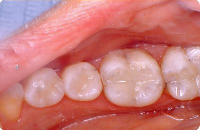 Dental checkup for female patient Composite fillings is general dentistry
