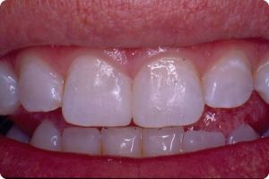 happy patient after dental bonding