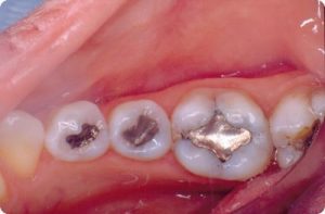 teeth with old silver fillings