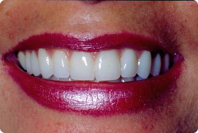 10 veneers placed by Long Island dentist Mitchell Shapiro, DMD. 10 veneers placed by Long Island dentist Mitchell Shapiro, DMD.