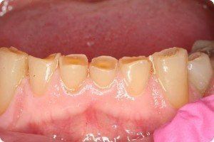 worn teeth before bonding Worn teeth before bonding