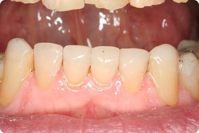 Long Island cosmetic dentist bonded teeth Dr. Shapiro restored teeth by composite bonding