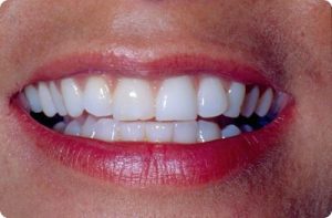 before porcelain veneers