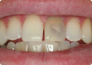 prebleach_opt(2)
