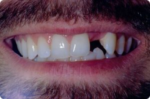 Man missing front tooth