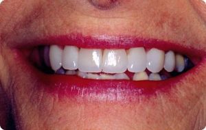 Porcelain veneers