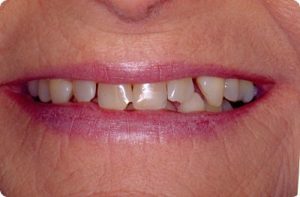 Porcelain veneers