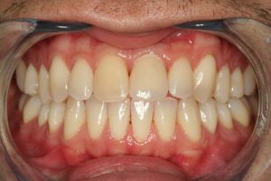 Implant front tooth