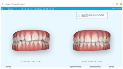 Invisalign outcome simulator