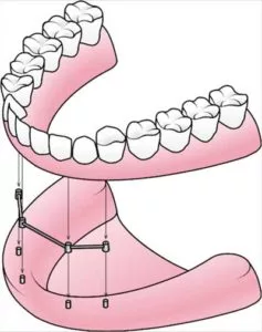 model of all-on-4 dental implants being placed