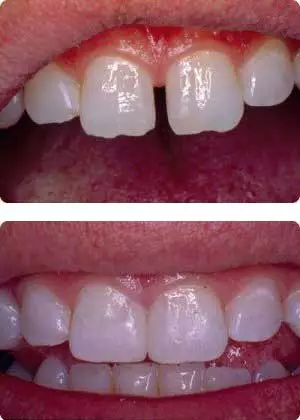 before and after dental bonding at Center for Cosmetic Dentistry