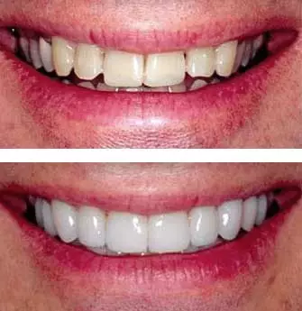 before and after dental veneers