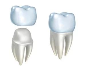 model of a dental crown being placed