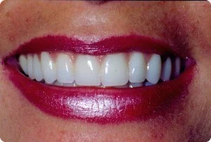 woman smiling with her new dental veneers